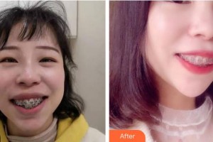 莆田群益口腔門(mén)診部徐超凡整形價(jià)格表附金屬托槽矯正牙齒案例展示