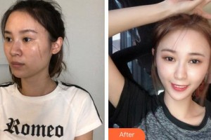 三明萬國美萊醫(yī)療美容外科門診部陳垂玉整形價格表附凹陷疤痕案例展示
