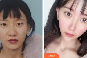 泉州美萊華美整形美容醫(yī)院盧剛整形價(jià)格表附鼻部手術(shù)+切開(kāi)雙眼皮案例展示