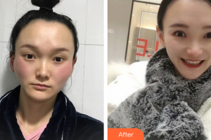廣州麗尚整形美容門(mén)診部吳昌鉉整形價(jià)格表附顴骨顴弓案例展示
