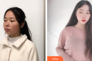 廣州麗尚整形美容門診部李安琪整形價(jià)格表附面部吸脂案例展示