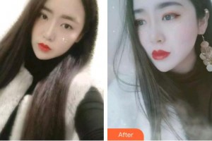 泉州泉興口腔門診部范桂菊整形價(jià)格表附金屬托槽矯正案例展示