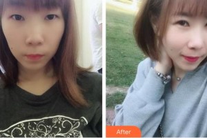 漳州市醫(yī)院整形美容科郭煒然整形價(jià)格表附切開雙眼皮案例展示