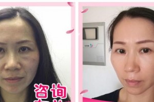 漳州正興醫(yī)院醫(yī)療美容中心陳紅整形價(jià)格表附不開刀去眼袋案例展示