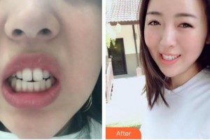 漳州衛(wèi)生職業(yè)學(xué)院附屬口腔醫(yī)院方雅君整形價(jià)格表附隱形矯正案例展示