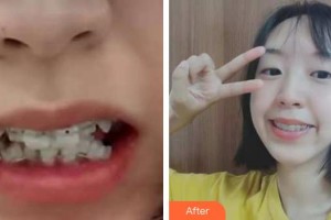 漳州佳美口腔門診部黃建欽整形價(jià)格表附牙齒矯正案例展示