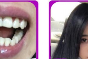 漳州佳美口腔門診部謝麗娟整形價(jià)格表附牙齒矯正案例展示