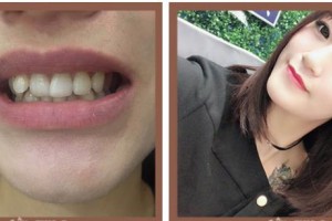 漳州佳美口腔門診部戴偉敏整形價(jià)格表附牙齒隱形矯正案例展示