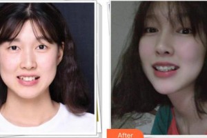 漳州佳美口腔門診部鄧少卿整形價(jià)格表附牙齒隱形托槽矯正案例展示