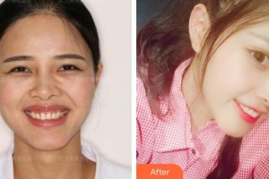 漳州佳美口腔門診部張亞群整形價(jià)格表附超薄牙貼面案例展示