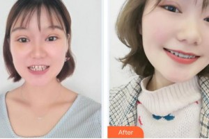 漳州佳美口腔門診部游玉玲整形價(jià)格表附牙綜合案例展示