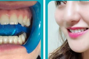 漳州佳美口腔門診部范美金整形價(jià)格表附牙齒美白案例展示