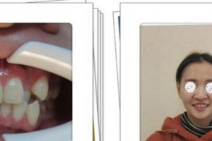 漳州佳美口腔門診部張健整形價(jià)格表附牙齒矯正案例展示