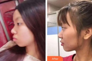 漳州佳美口腔門診部劉挺整形價(jià)格表附金屬托槽矯正案例展示