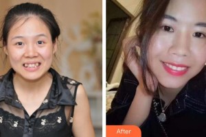 漳州佳美口腔門診部吳燕惠整形價(jià)格表附金屬托槽矯正案例展示