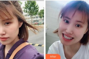 漳州佳美口腔門診部王泳洲整形價(jià)格表附金屬托槽牙齒矯正案例展示
