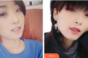 漳州佳美口腔門診部陳雋整形價(jià)格表附超聲波洗牙案例展示