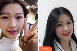 漳州佳美口腔門診部黃志達(dá)整形價(jià)格表附隱形矯正案例展示
