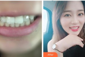 漳州佳美口腔門診部吳日耀整形價(jià)格表附金屬托槽矯正案例展示