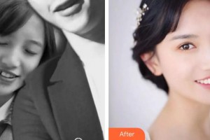 漳州佳美口腔門診部童斌斌整形價(jià)格表附金屬托槽矯正案例展示