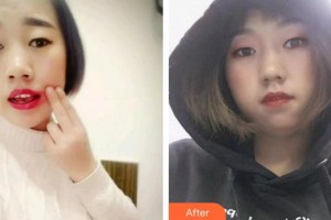 漳州衛(wèi)生職業(yè)學(xué)院附屬口腔醫(yī)院劉慧芬整形價(jià)格表附牙齒根管調(diào)節(jié)案例展示
