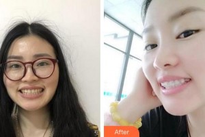 漳州衛(wèi)生職業(yè)學(xué)院附屬口腔醫(yī)院劉華英整形價(jià)格表附牙齒金屬矯正案例展示