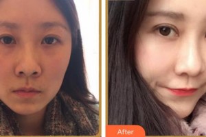 寧德韓美整形美容醫(yī)院黃鑫彬整形價格表附眼部整形案例展示