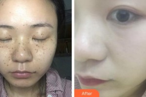 寧德442醫(yī)院整形美容中心姜敏整形價格表附超激光美膚祛斑案例展示