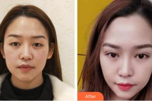 寧德眼科醫(yī)院蘇宗平整形價格表附眼部整形案例展示