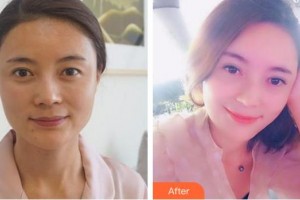 安徽立新醫(yī)學美容門診部徐商熏整形價格表附半年的韓式全切雙眼皮案例展示