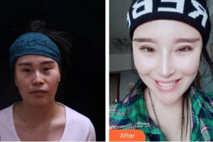 安徽立新醫(yī)學美容門診部李戰(zhàn)強整形價格表附鼻部手術(shù)案例展示