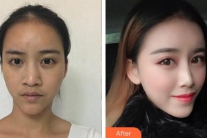 安徽醫(yī)科大學第一附屬醫(yī)院整形美容中心寧金龍整形價格表附鼻部手術(shù)案例展示