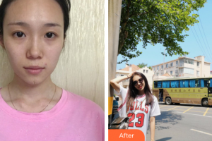 廣州博研醫(yī)療美容門診部何仁亮整形價格表附手術(shù)疤痕案例展示