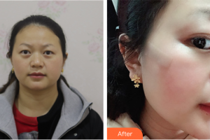 廣州博研醫(yī)療美容門診部田艷麗整形價格表附面部疤痕修復案例展示
