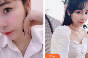 廣州柏德口腔門(mén)診部蘭海龍整形價(jià)格表附合金烤瓷牙案例展示