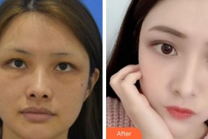 合肥華美整形美容醫(yī)院梁偉中整形價格表附埋線提升案例展示