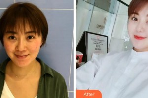 合肥臺美醫(yī)療美容門診部陳宏榮整形價(jià)格表附埋線提升案例展示