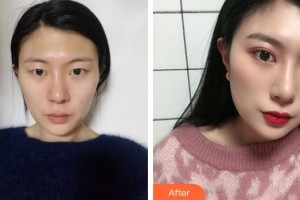 合肥美舒雅醫(yī)療美容診所尹洋整形價格表附切開雙眼皮案例展示