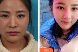 合肥恒美整形醫(yī)院陳亮整形價格表附眼部綜合案例展示