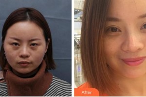 合肥名人眼科醫(yī)院岳春整形價格表附重瞼修復術(shù)+上瞼提肌矯正術(shù)案例展示