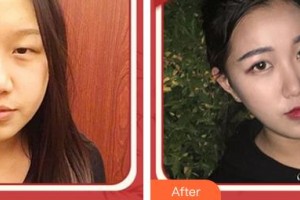 合肥愛爾眼科醫(yī)院汪寧整形價格表附眼部綜合案例展示