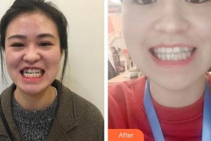 合肥瑞特曼口腔門診部黃志整形價格表附牙齒隱形矯正案例展示