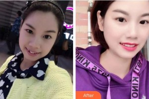 合肥拜博口腔醫(yī)院徐美平整形價格表附牙綜合案例展示