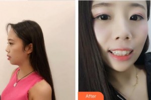 合肥拜博口腔醫(yī)院翁士云整形價格表附牙齒隱形矯正案例展示