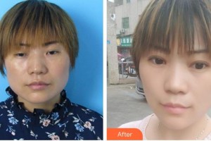 合肥東南眼科醫(yī)院葉玉華整形價(jià)格表附上瞼下垂、內(nèi)眼角案例展示