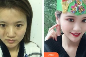 蚌埠韓麗整形美容醫(yī)院梁青整形價格表附疤痕祛除案例展示