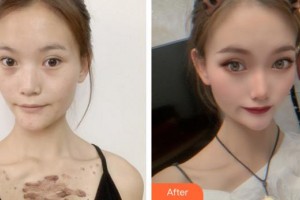 蚌埠市第三人民醫(yī)院燒傷整形科楊蔚整形價格表附微創(chuàng)疤痕修復(fù)案例展示