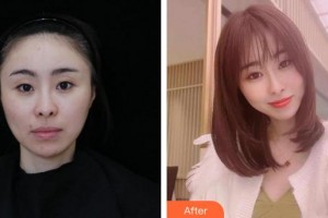 蚌埠美萊塢整形美容醫(yī)院趙士駿整形價格表附膠原蛋白除皺案例展示
