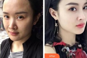 蚌埠韓麗整形美容醫(yī)院康寶峰整形價格表附熱瑪吉案例展示