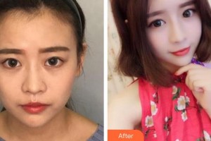蚌埠靚妹醫(yī)療美容門診部葉麗琴整形價(jià)格表附熱瑪吉案例展示